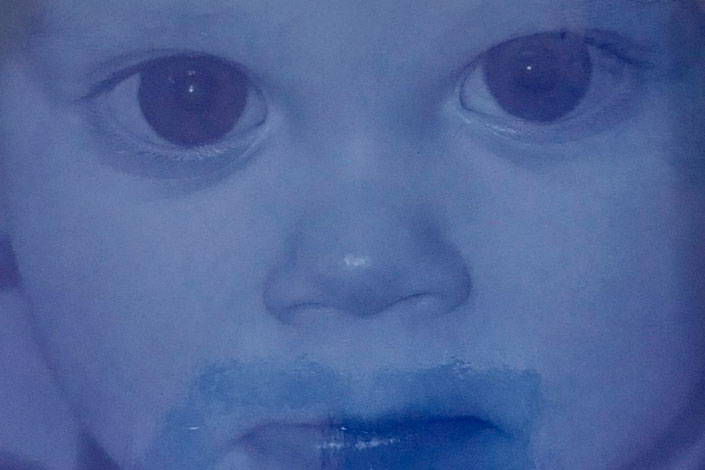 glaucoma en la infancia - portada